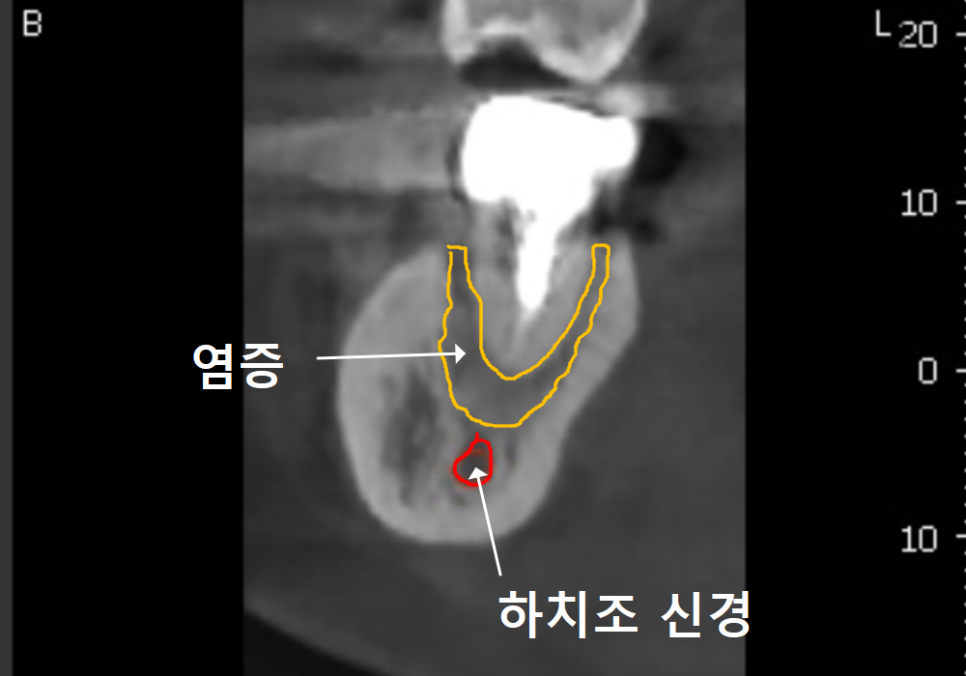 고덕역 임플란트, 뼈이식 꼭 해야 할까? 필수 상황 vs 제외 상황 총정리 관련 이미지 9