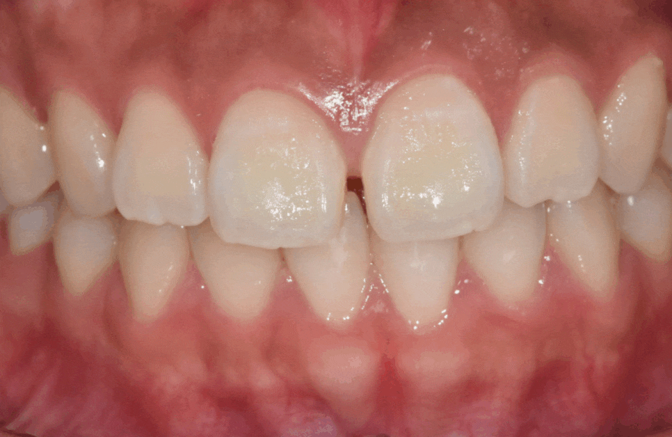 3 Ways to Fix Gaps Between the Front Teeth with Orthodontic Treatment image 1