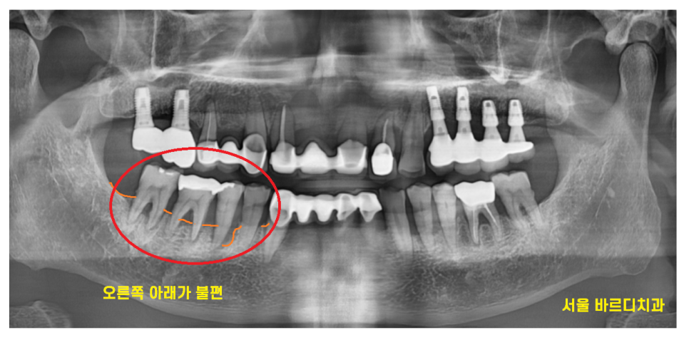 하남시청치과 치아 욱신거림 임플란트로 치료해드렸습니다. 관련 이미지 2