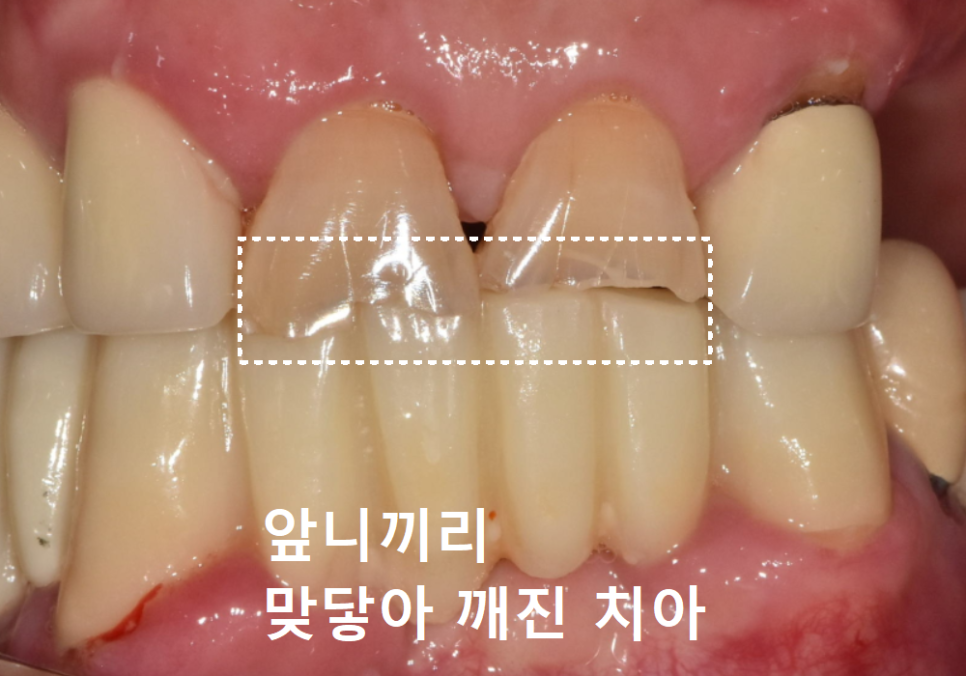 Godeok-dong Tooth Fracture: Check This Before Getting an Implant! Revealing the Criteria for Saving It image 6