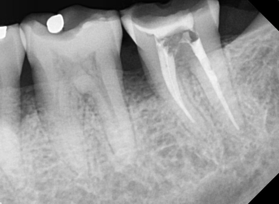 Implant Treatment for a Fractured Molar Split in Half After Neglect Following Root Canal Treatment image 2