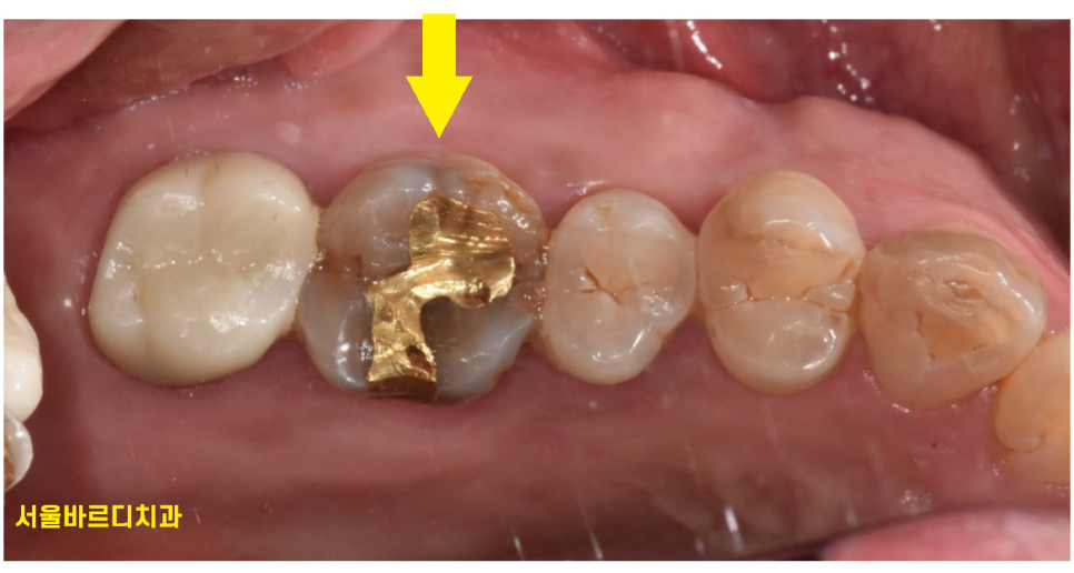 풍산동 치과 골드 인레이 치료했던 치아가 또 충치가 생김. 관련 이미지 2