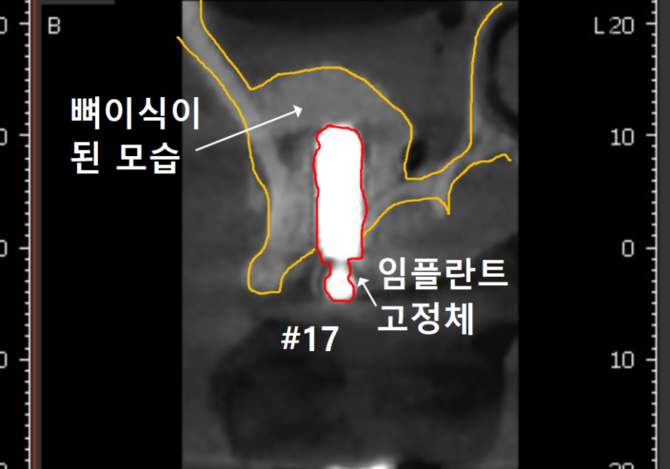 상악동 거상술 부작용 걱정되시나요? 재수술 없는 뼈이식의 정석 공개 관련 이미지 12