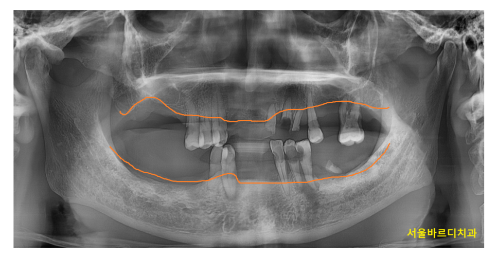 상일동 치과 치아 하나 빠지면 시작 됐을 수 있습니다 관련 이미지 1