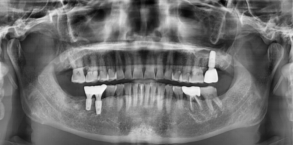 망월동 치과 임플란트 보철 불편 볼 씹힘, 이질감 그 사이에서 관련 이미지 3
