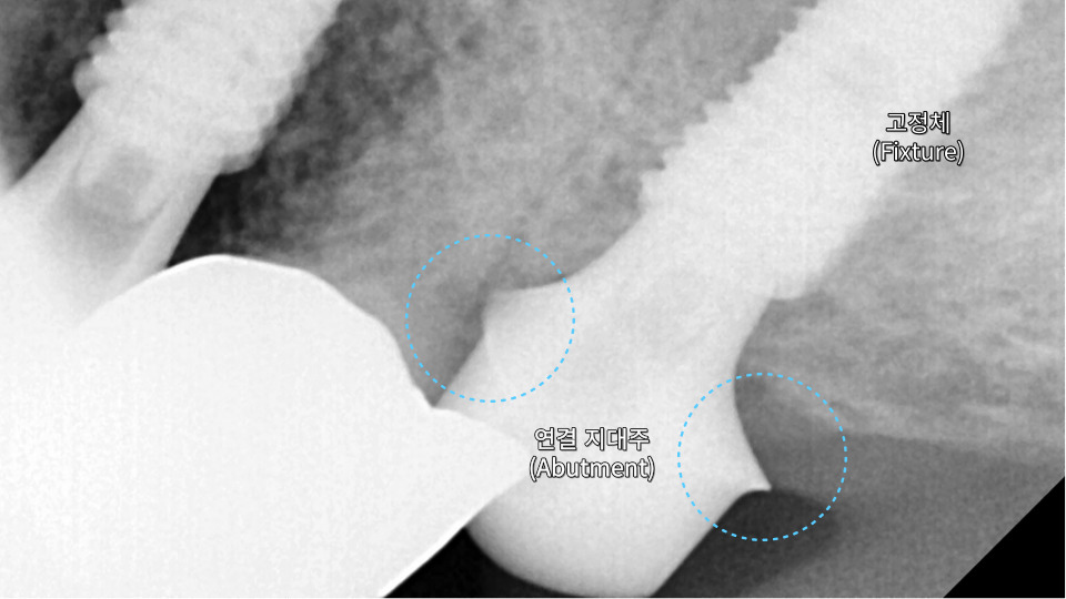 서울바르디치과 뿌리 끝 염증 심한 치아를 네비게이션 임플란트 #6 관련 이미지 17