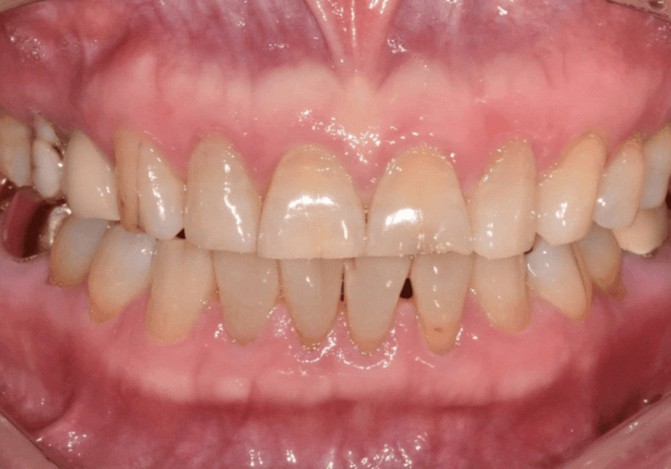 고덕동 앞니 보철, 브릿지와 싱글 크라운, 어떤 선택이 나에게 더 유리할까? 관련 이미지 11