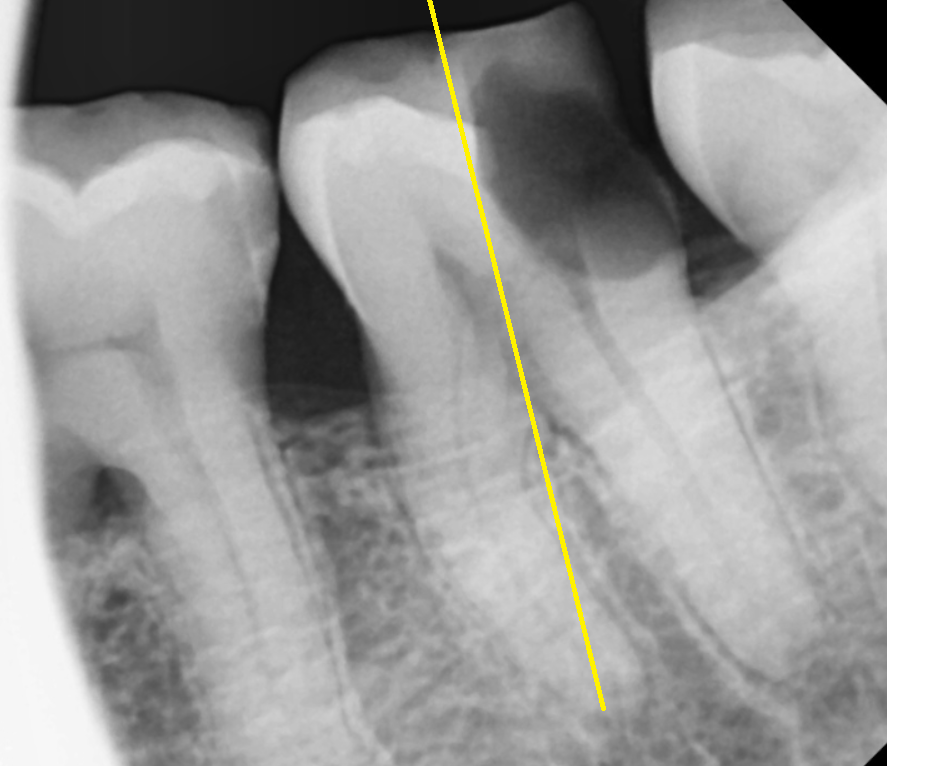 천호동 치과 충치로 인하여 손상된 치아 임플란트로 대처하기 관련 이미지 3