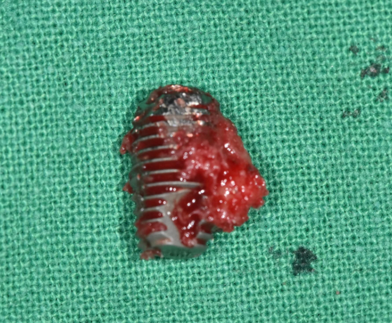 임플란트 식립 실패 너무 속상하시죠? 관련 이미지 2