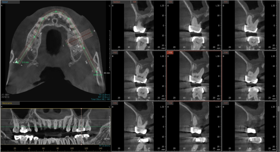 고덕동치과 서울바르디치과 무절개 네비게이션 임플란트 치료증례 #2 관련 이미지 9