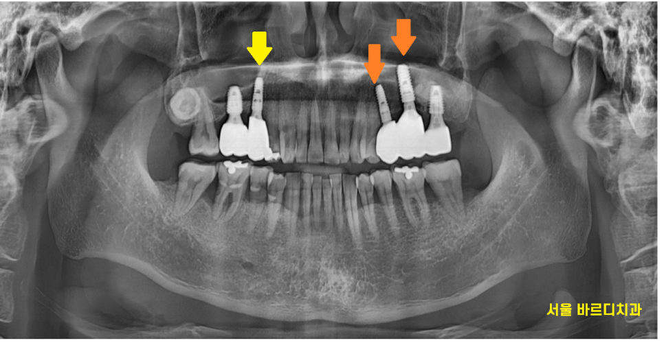 상일동 치과 잇몸 내려감 치료는 임플란트로 관련 이미지 9