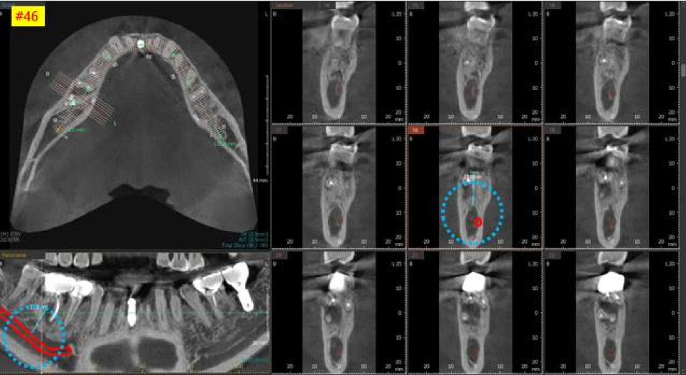 서울바르디치과 상하악 대구치 네비게이션 임플란트 치료증례 #4 관련 이미지 9