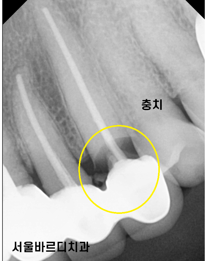 상일동 치과 충치로 인한 앞니 브릿지 파절 재건해보았습니다. 관련 이미지 5
