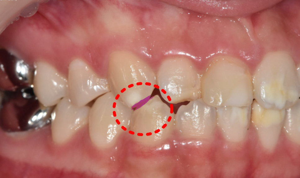 강동구 라미네이트, 치아 하얀 반점 없애고 싶다면? 치료 방법 관련 이미지 7