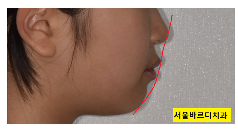 입툭튀 교정 돌출입 수술 없이 가능할까? 관련 이미지 5