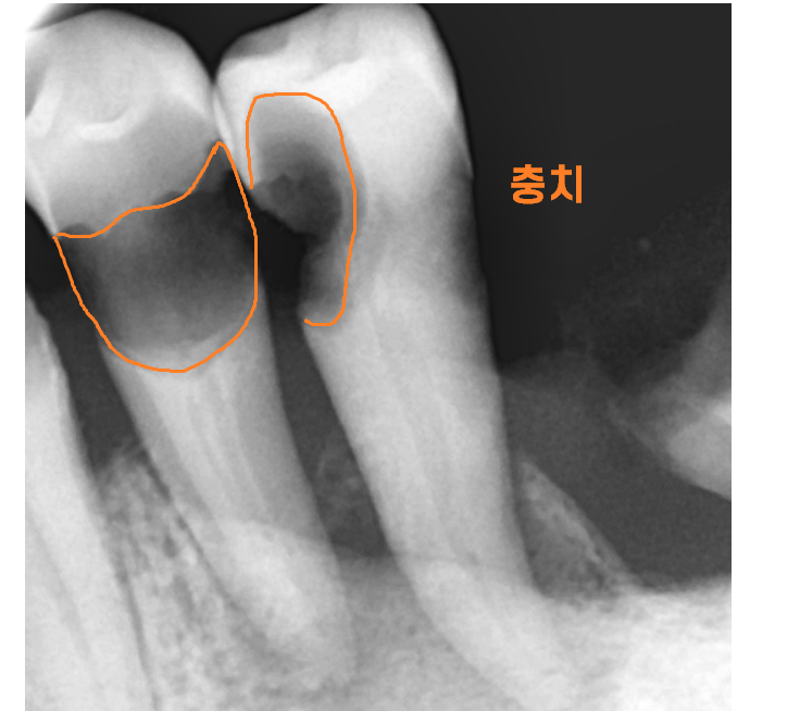 상일동 임플란트 잘하는곳 치료는 이렇게 진행됩니다. 관련 이미지 4