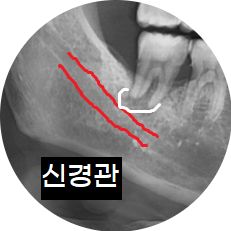 신경 임플란트 가까울때 안전하게 심을 수 있는 지연 식립법 공개 관련 이미지 3