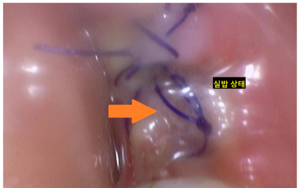 고덕동 임플란트 후 양치 이렇게 해야합니다. 관련 이미지 2