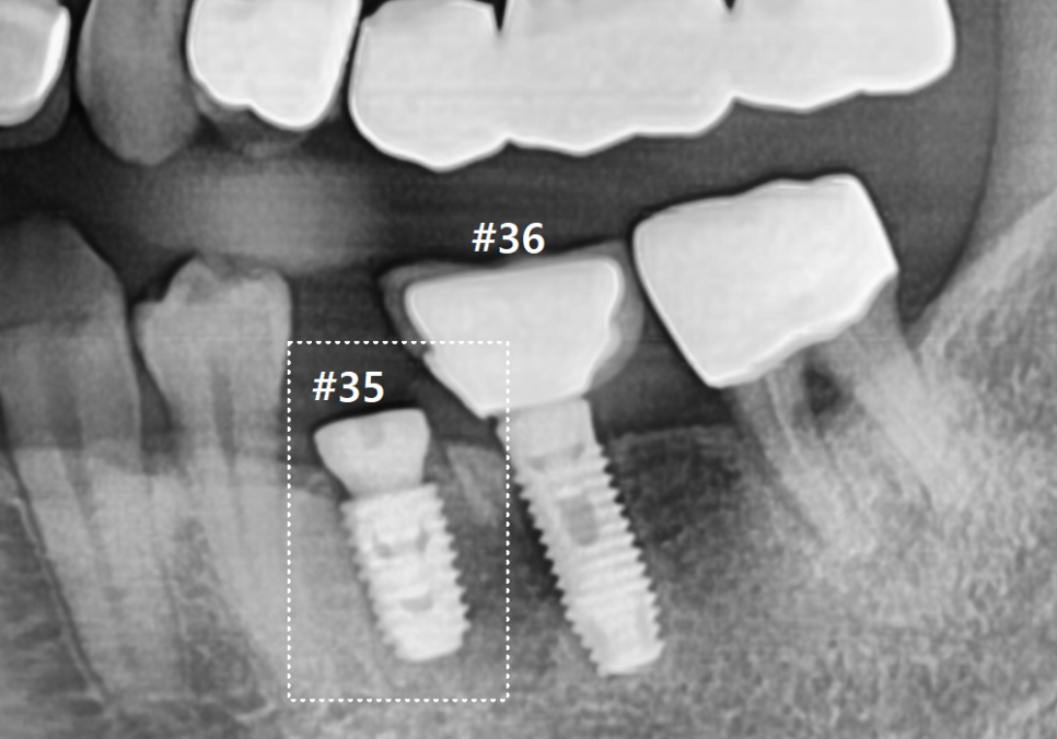 상일역 임플란트, 음식물 끼는 이유, 처음엔 안 그랬는데 왜 점점 심해지는 걸까요? 관련 이미지 10