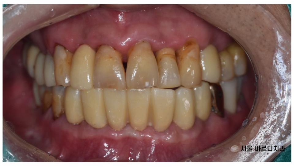 강일동 임플란트 위아래 치아 흔들림과 통증이 있을 때 방법은? 관련 이미지 10
