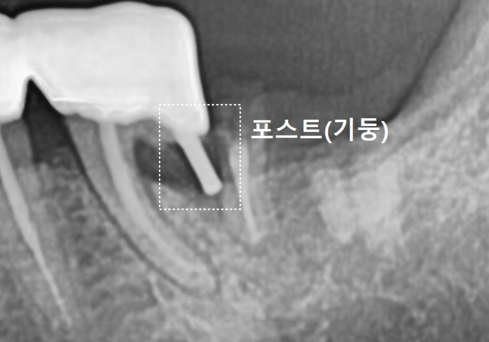강동구 임플란트 기간, 사람마다 왜 다를까? 즉시식립과 지연식립의 결정적 차이 관련 이미지 12