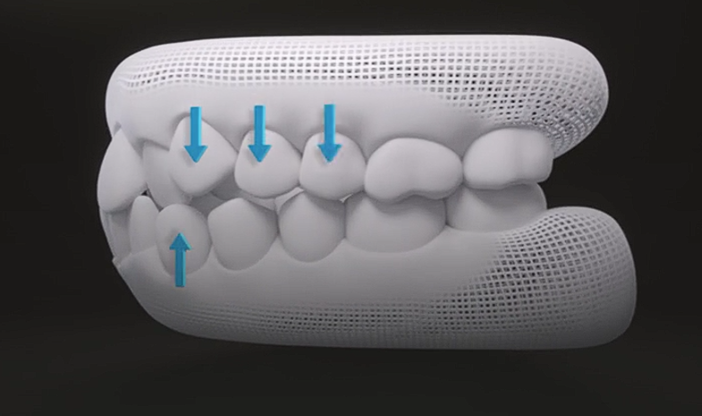 서울 투명교정 이거 모르면 후회합니다. 관련 이미지 5