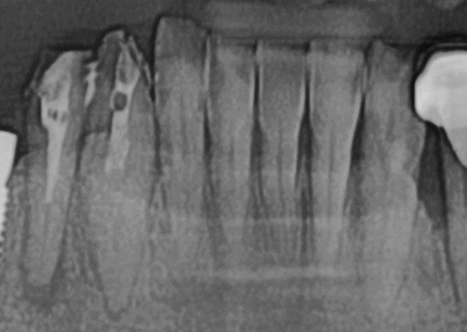 치아 뿌리 염증 빼야 된다는 치아, 이렇게 살렸습니다. 치료 방법 관련 이미지 6