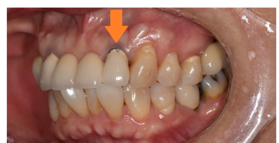 Orthodontic Bracket Debonding: Please Pay Attention If You Have Many Prosthetic Restorations image 4