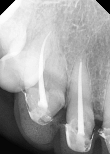 고덕동 심미 보철, 삐뚤어진 앞니, 교정 없이 바로잡은 비결 관련 이미지 8