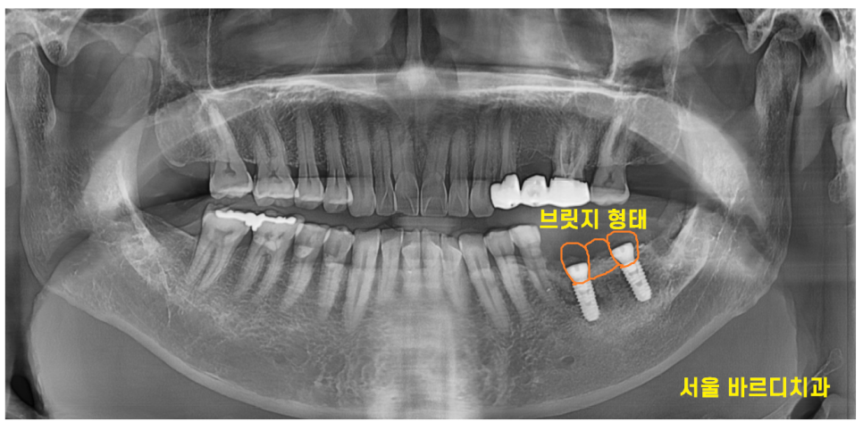 강일동 임플란트 씌운 치아 통증 불편할 때는 치과를 방문해주세요 관련 이미지 7