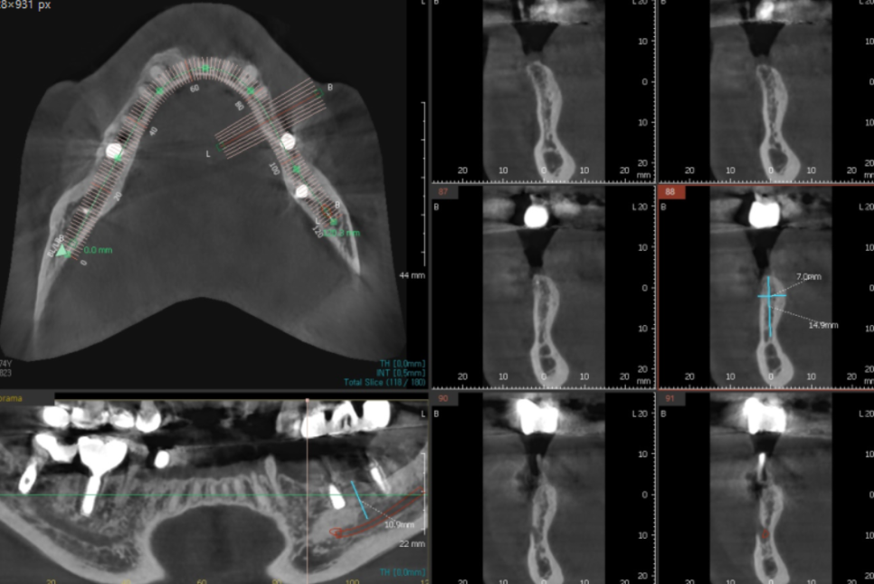 망월동 치과  양쪽 어금니 문제가 있을때 치료 순서는? 관련 이미지 5