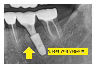 비절개 임플란트 추구하는 3가지 이유 관련 이미지 1