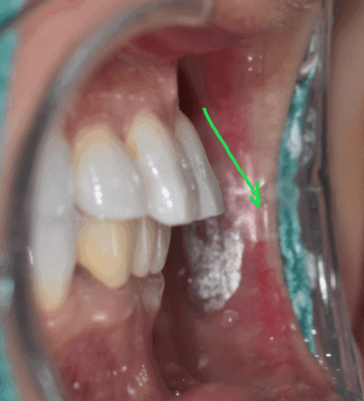 Solved My Concerns About Protruding Front Teeth with Partial Re-orthodontic Treatment of the Front Teeth image 1
