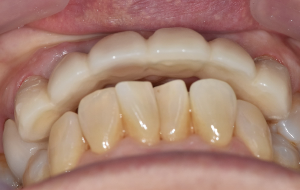 명일동 앞니 브릿지, 새로 교체 할 때 꼭 확인해 봐야 할 관련 이미지 9