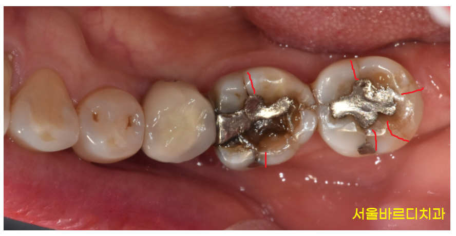 씹을때 찌릿 치아균열증후군 보이지 않아 위험합니다. 관련 이미지 4