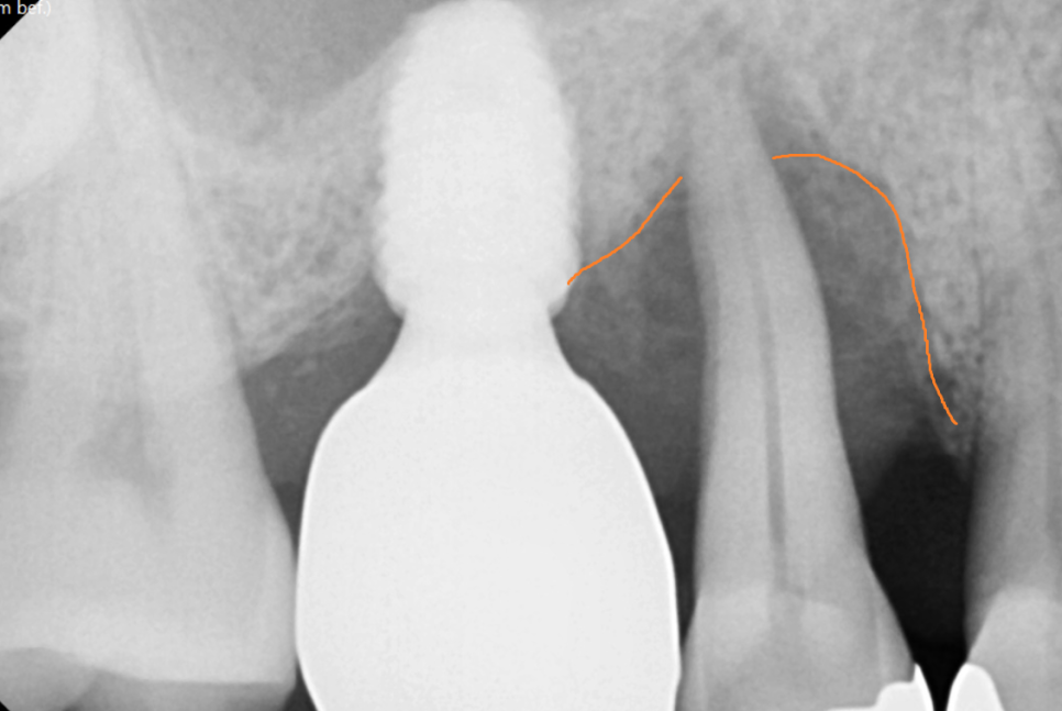 상일동 치과 잇몸 내려감 치료는 임플란트로 관련 이미지 3