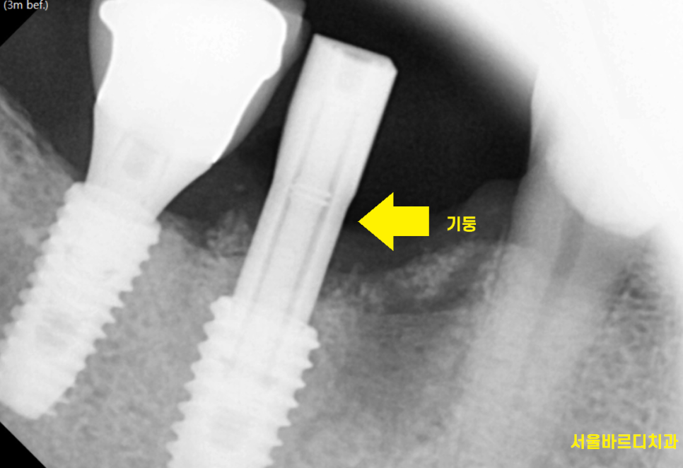 암사동 치과 치아 뿌리 균열 금 갔을 때 임플란트 치료로 행복해지세요. 관련 이미지 7