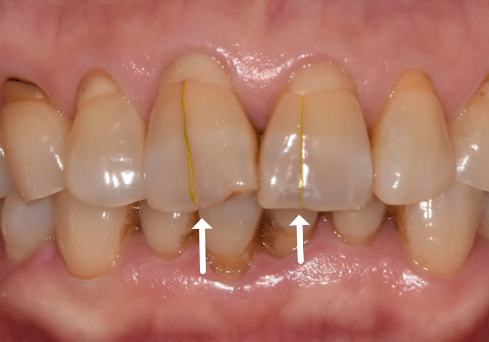 마모된 윗 앞니가 까맣게 변했다면? 방치하면 안 되는 이유 관련 이미지 1