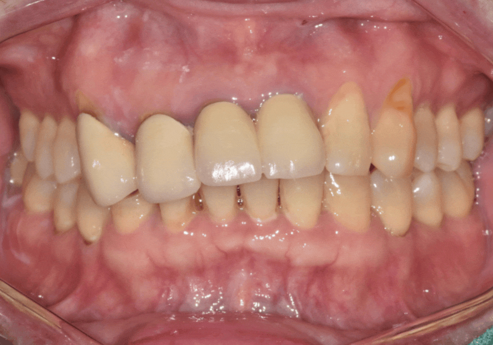 고덕동 심미 보철, 삐뚤어진 앞니, 교정 없이 바로잡은 비결 관련 이미지 16