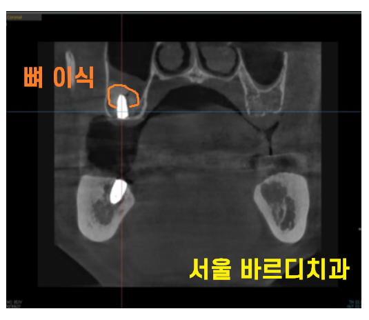 명일동 치과 임플란트 위아래 같이 한꺼번에 할 수 있나요?? 관련 이미지 5