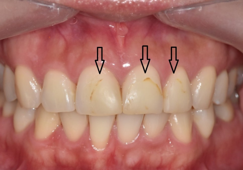 상일동역 라미네이트, 왜 누군가는 부작용을 겪고, 누군가는 10년 넘게 멀쩡할까? 관련 이미지 5
