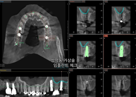 서울바르디치과 뿌리 끝 염증 심한 치아를 네비게이션 임플란트 #6 관련 이미지 9