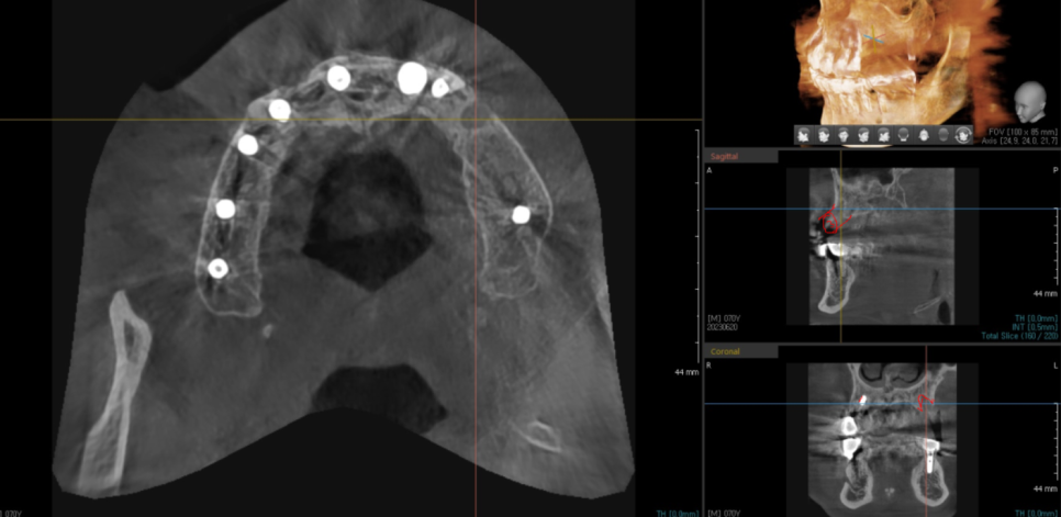 덕풍동 치과 오래된 임플란트 제거 후 재식립하였습니다. 관련 이미지 10