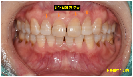 앞니 치아 사이 벌어짐 라미네이트로 컴플렉스 극복! 관련 이미지 5
