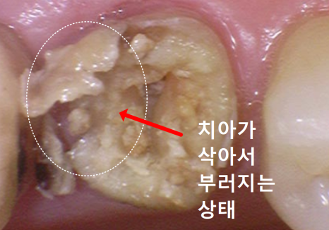 앞니 브릿지 탈락, 씌워둔 게 빠졌어요. 다시 붙일 수 있을까요? 관련 이미지 2