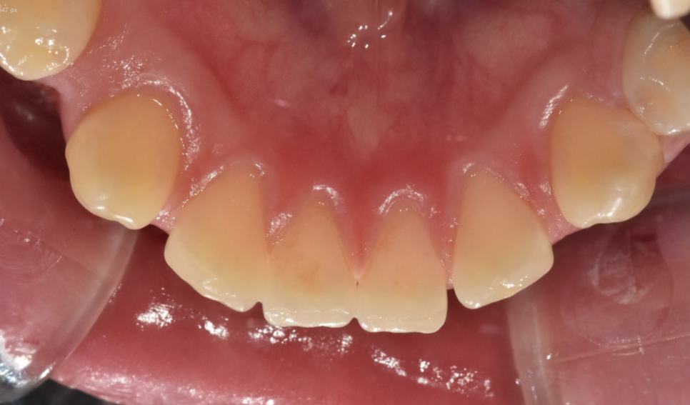 벌어진 앞니 치아 교정 통해 공간 닫기 장점이 많습니다. 관련 이미지 6