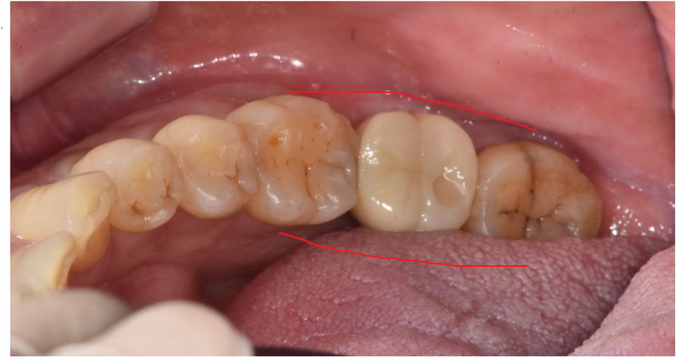 천호동 치과 충치로 인하여 손상된 치아 임플란트로 대처하기 관련 이미지 8