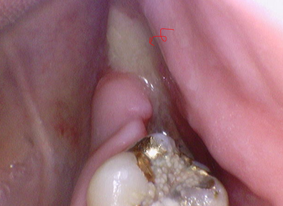 상악동염 이비인후과 치료 후 임플란트를 해야할 수 있습니다. 관련 이미지 3