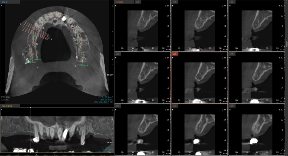 오늘 임플란트 심고, 내일 씹는게 가능하다고요?? (잔존골은 정답을 알고있다) 관련 이미지 2