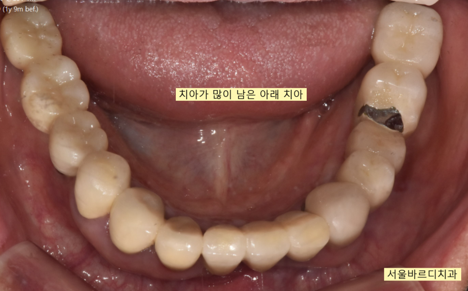 상일동 치과 부분 틀니에서 임플란트 바꿔서 사용하기 관련 이미지 6